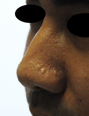 Nose Laser Resurfacing Scar Revision Lateral Left View