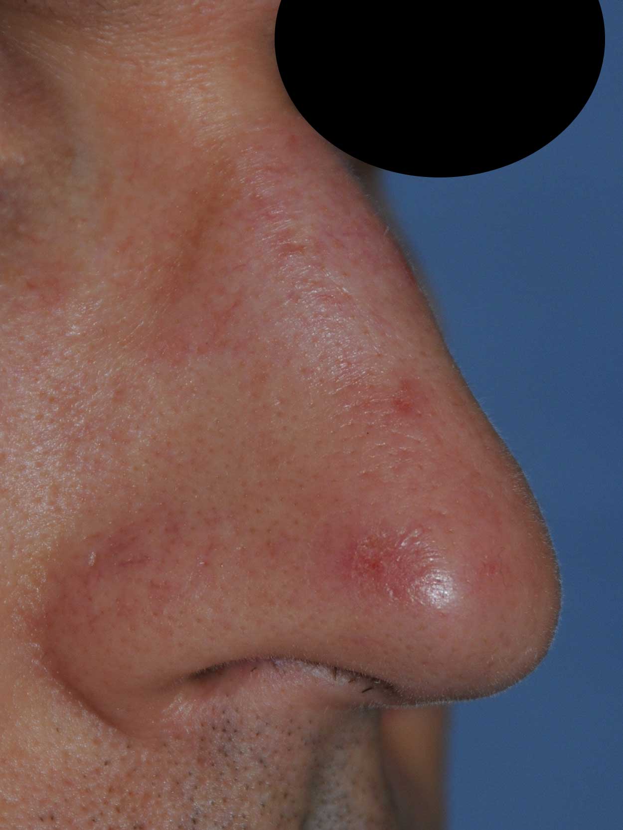 Oblique View Before Laser Resurfacing, Dermabrasion to the nose to treat scars, red marks, to improve texture, tone and even the skin appearance for this 40's Caucasian Professional Male from Bellevue, Wa