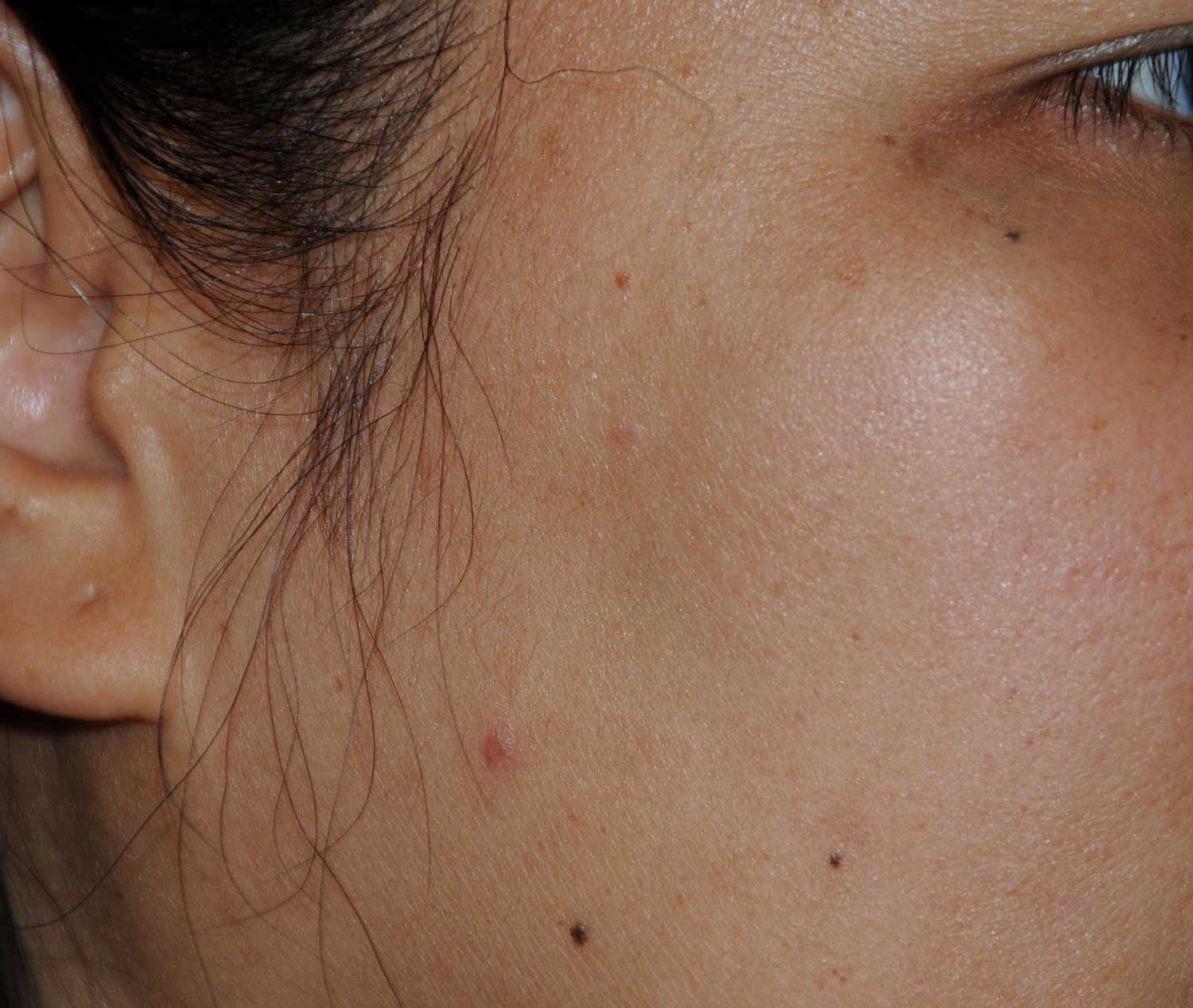 Birthmark Removal for this Middle Aged Professional Asian Female After View Image