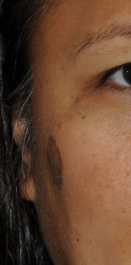 Birthmark Removal for this Middle Aged Professional Asian Female Before View Image