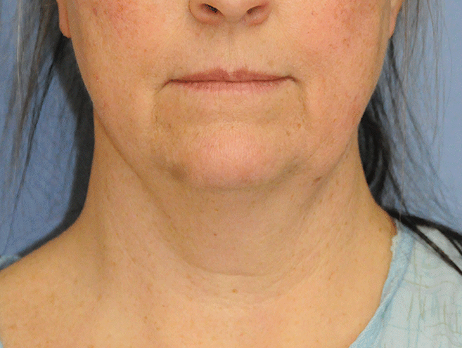 60's Caucasian Female with Double Chin Turkey Neck Sagging & Laxity, Facial Jowling & Neck Banding Before Neck Lift Front View