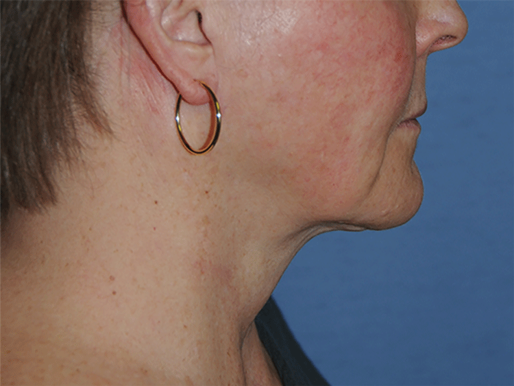 60's Caucasian Female From Greater Everett Area with Double Chin Turkey Neck Sagging & Laxity, Facial Jowling & Neck Banding After Neck Lift Front View