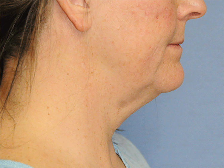 60's Caucasian Female From Greater Everett Area with Double Chin Turkey Neck Sagging & Laxity, Facial Jowling & Neck Banding Before Neck Lift Side View