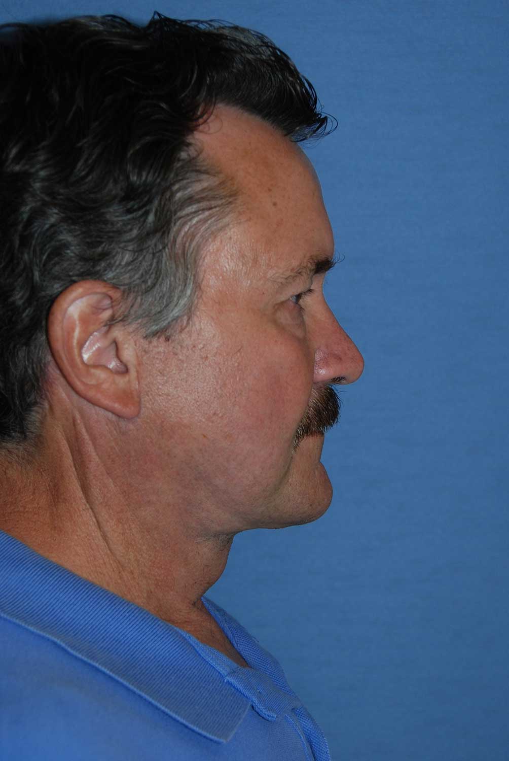 60's Caucasian Male with Severe Neck Sagging & Laxity, Facial Jowling & Platysmal Muscle Banding After Face Lift NeckLift Lateral View