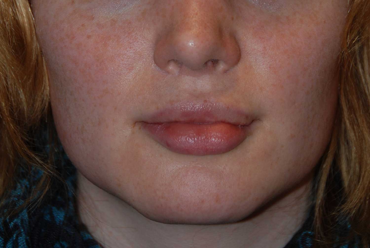 Front View After Chin Reduction / Re-shaping and Lip Enhancement with a V-Y Advancement Flaps
