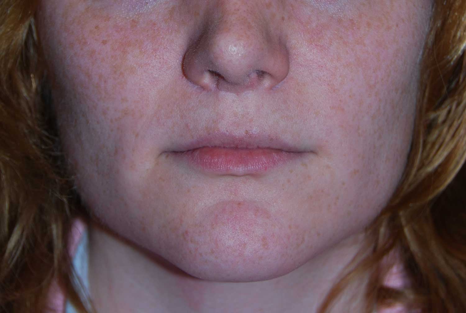 Front View Before Chin Reduction / Re-shaping and Lip Enhancement with a V-Y Advancement Flaps