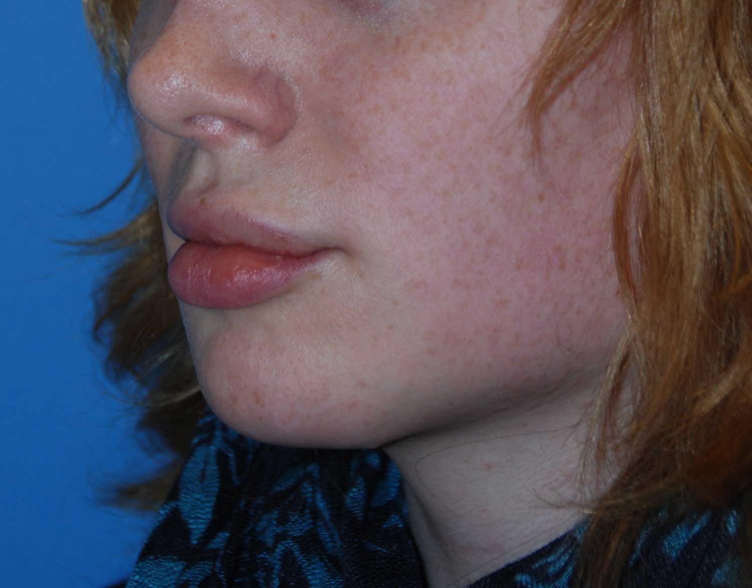 Oblique View After Chin Reduction / Re-shaping and Lip Enhancement with a V-Y Advancement Flaps
