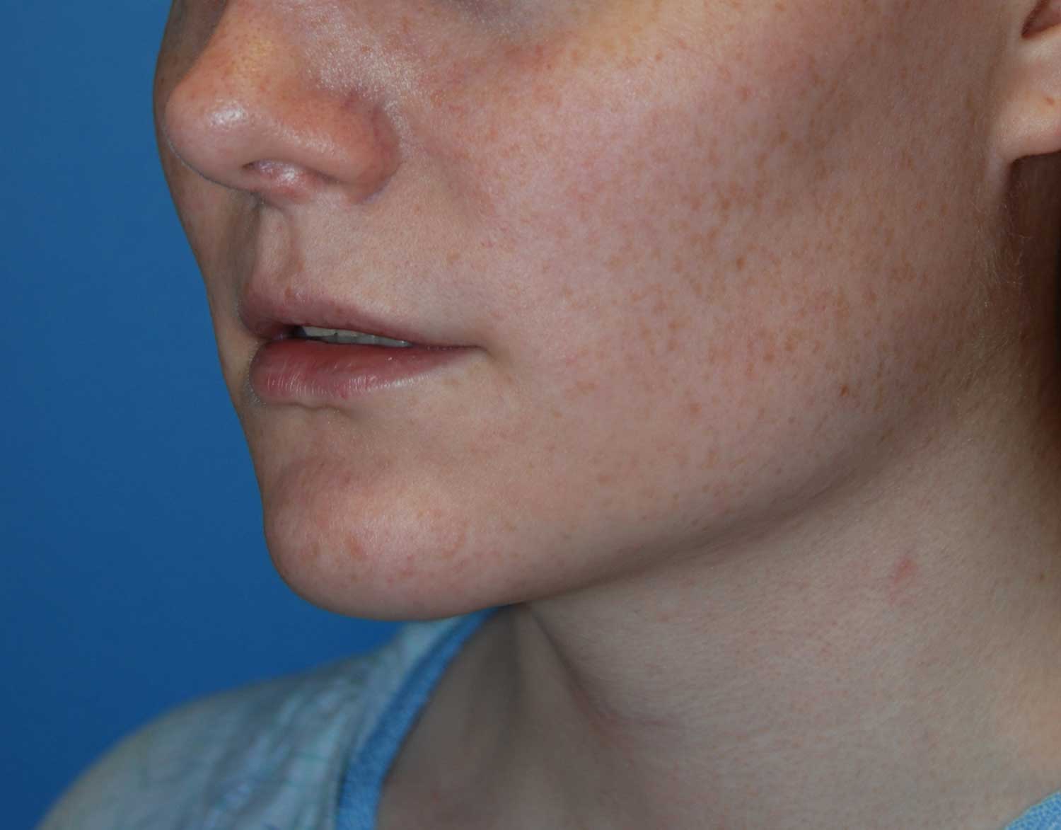 Oblique View Before Chin Reduction / Re-shaping and Lip Enhancement with a V-Y Advancement Flaps