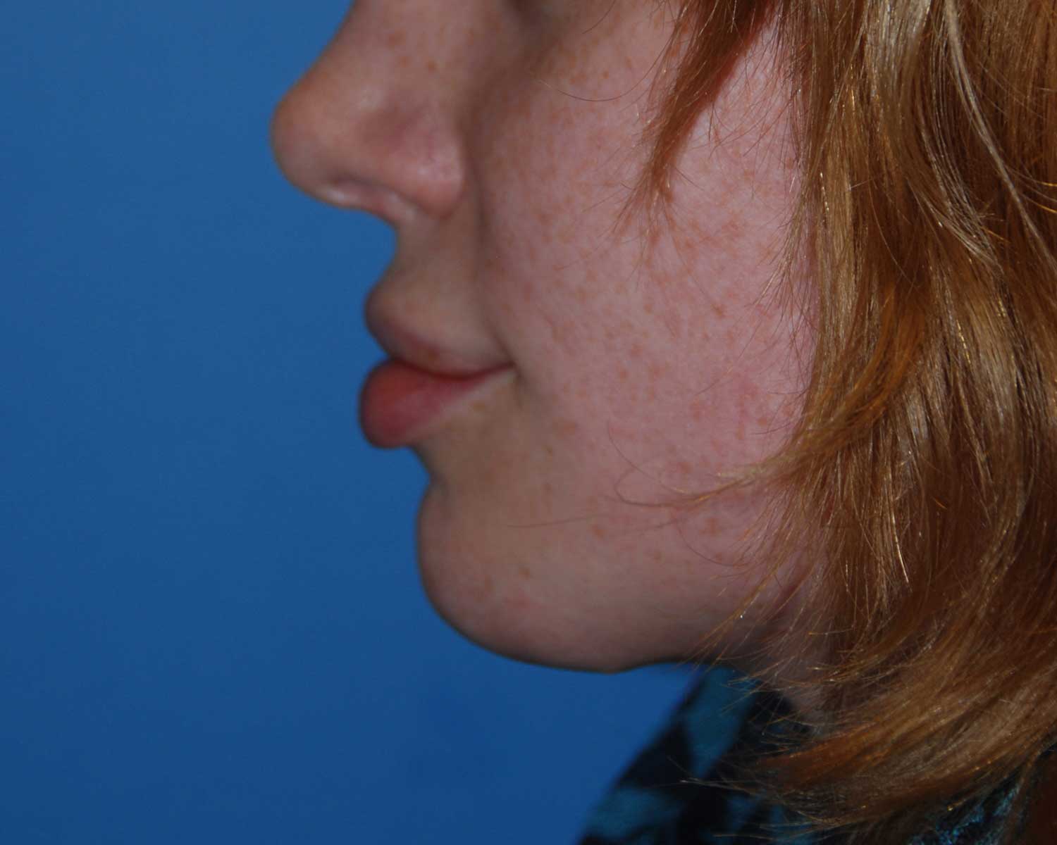After Chin Reduction / Re-shaping and Lip Enhancement with a V-Y Advancement Flaps