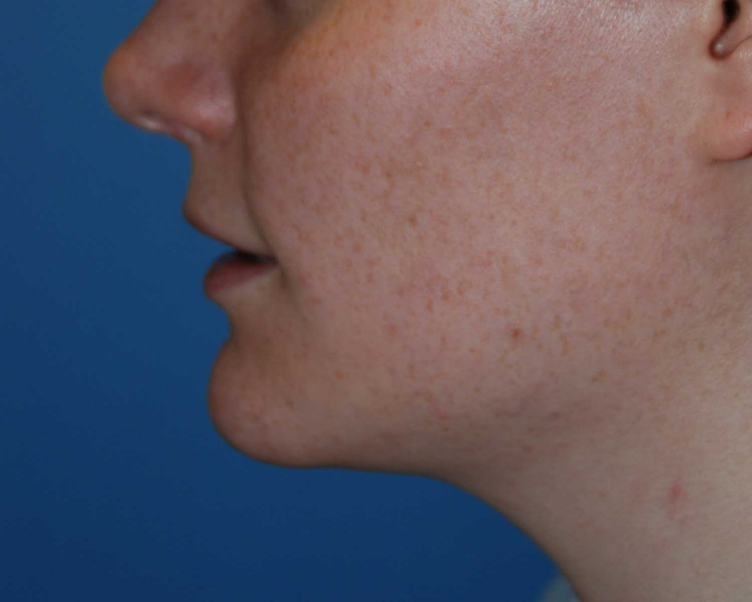 Before Chin Reduction / Re-shaping and Lip Enhancement with a V-Y Advancement Flaps