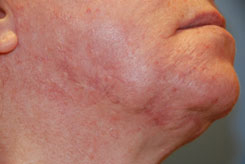 Acne Scar Treatment Before & After Photo