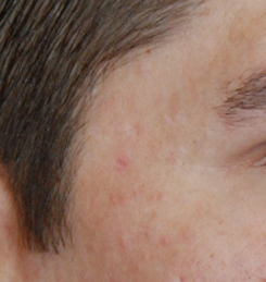 Acne Scar Treatment Before & After Photo