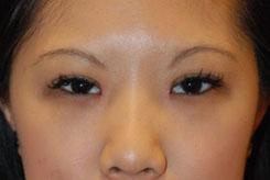 Eyelift Before & After Photo