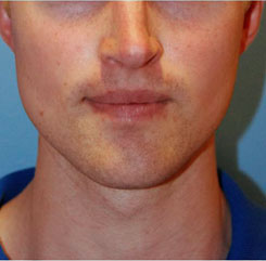 Jaw Implants Before & After Photo