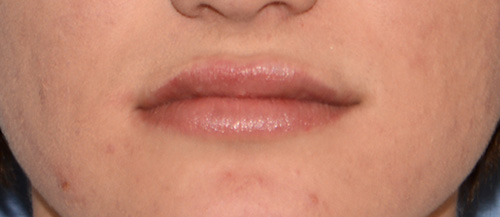 Lip Augmentation / Injection Before & After Photo