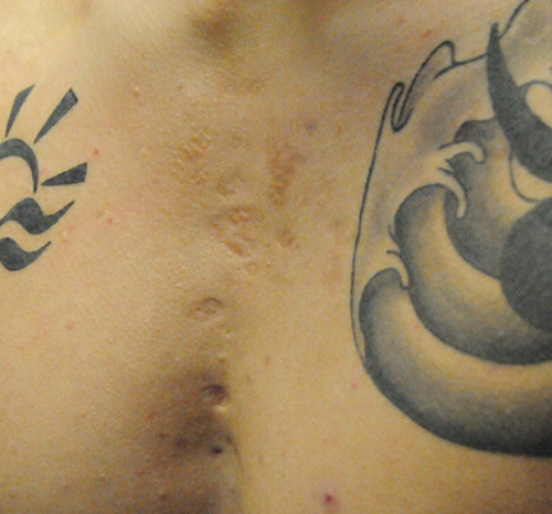 Scar Revision Before & After Photo