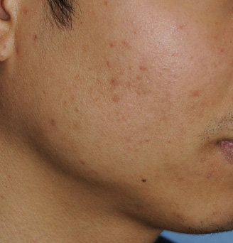 Chemical Peel Before & After Photo