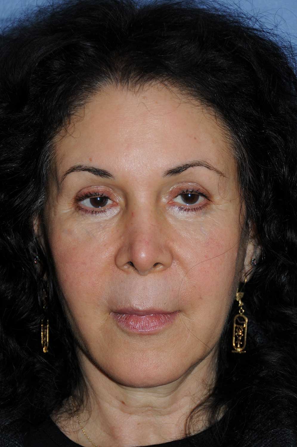Incision Less Face Lift Eyelift After Image Front View