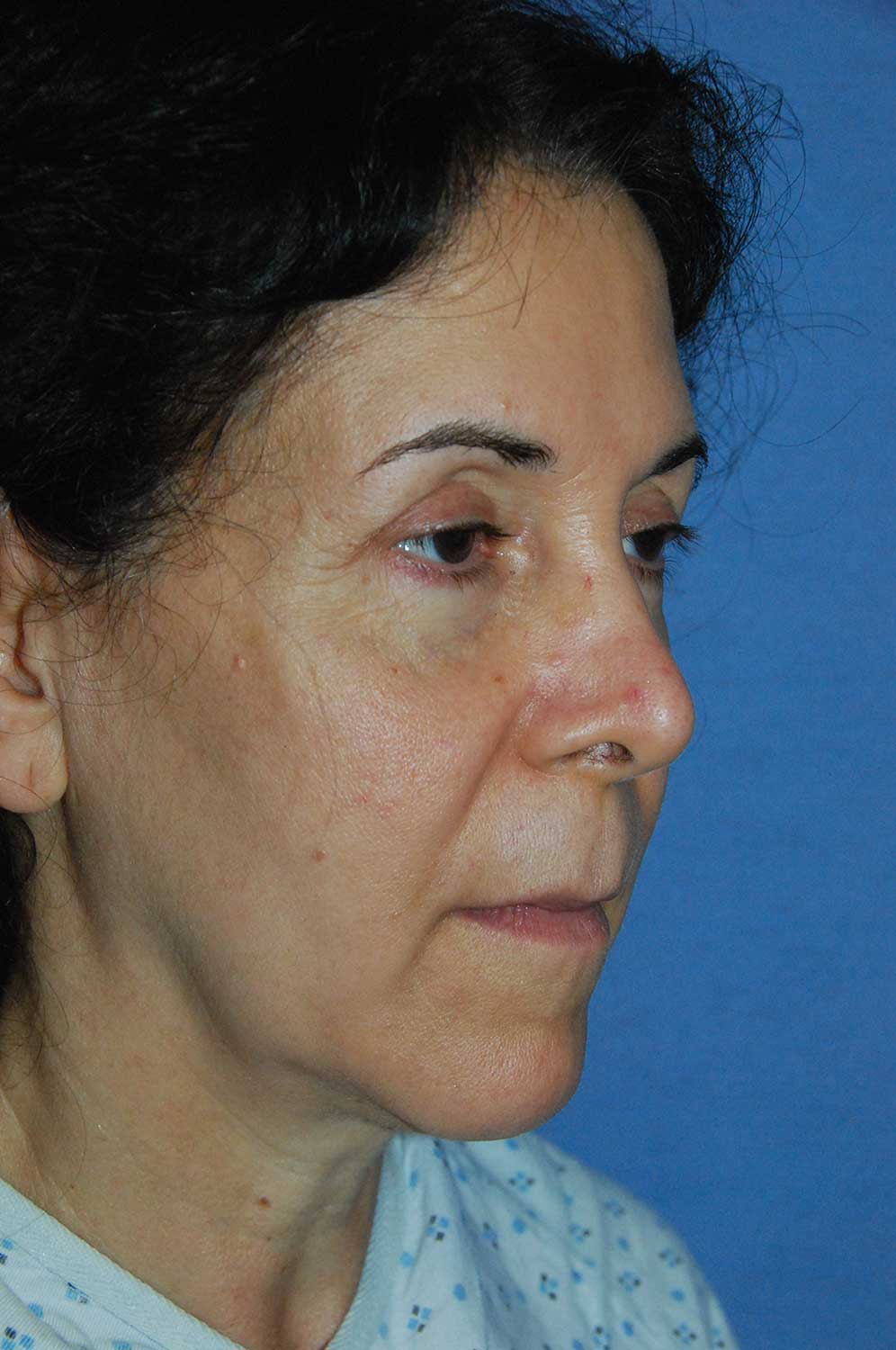 Incision Less Face Lift Eyelift Before Image Oblique View