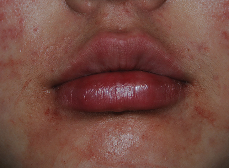 Lip injections immediately after injections