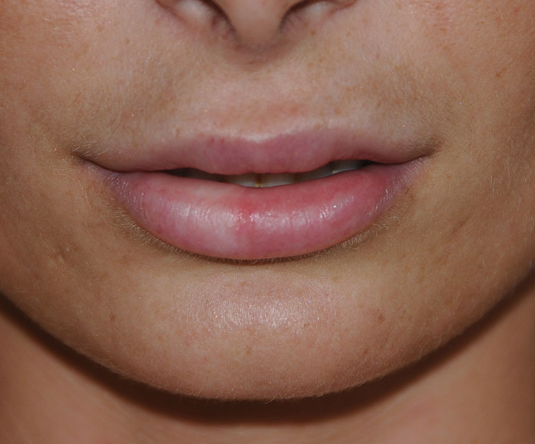 Lip Filler Injections After with Restylane®