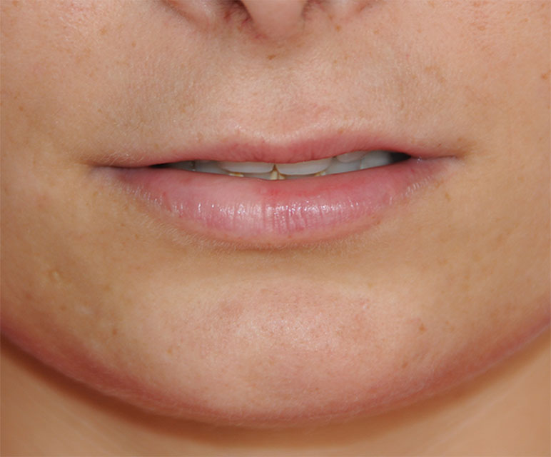 Lip Filler Injections Before with Restylane®