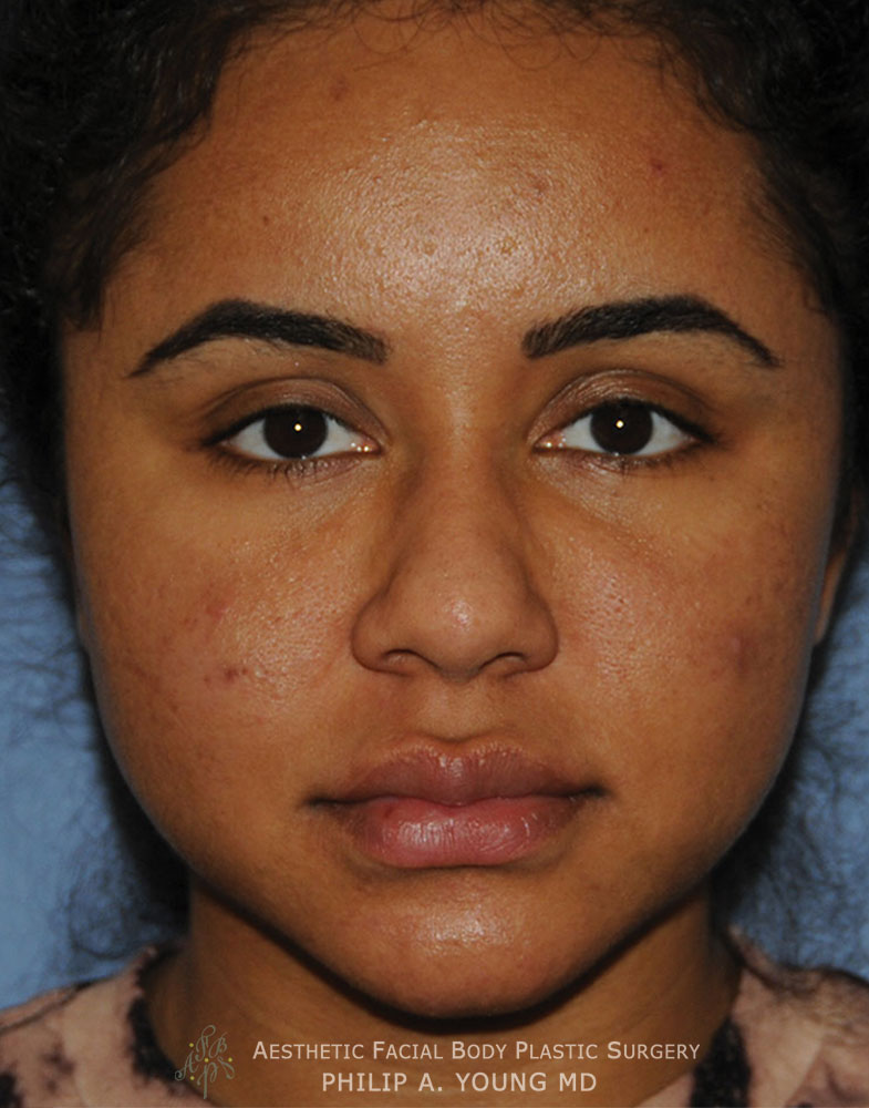 Lip Injection | Augmentation Before & After Photos Seattle Bellevue