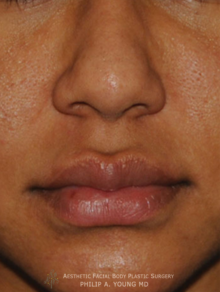 After Upper Corner of the Liplift and Right Upper Mole Laser Removal Close Up