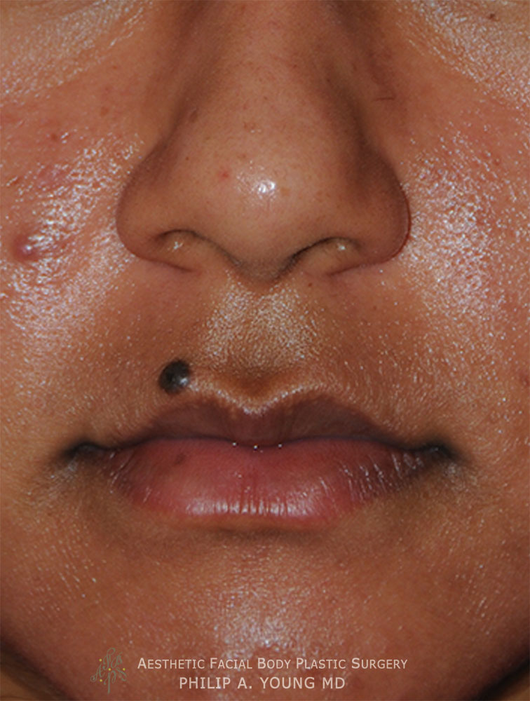 Before Upper Corner of the Liplift and Right Upper Mole Laser Removal Close Up