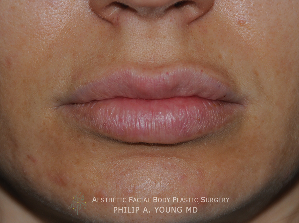 After Lip Reduction | Thinning For a Successful Fat Injection Procedure that the patient wanted reversed