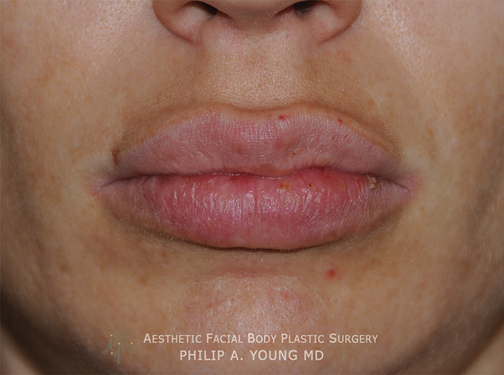  Before Lip Reduction | Thinning For a Successful Fat Injection Procedure that the patient wanted reversed