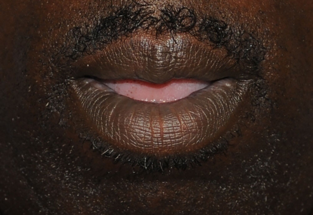 lip thinning reduction for an african black american after image