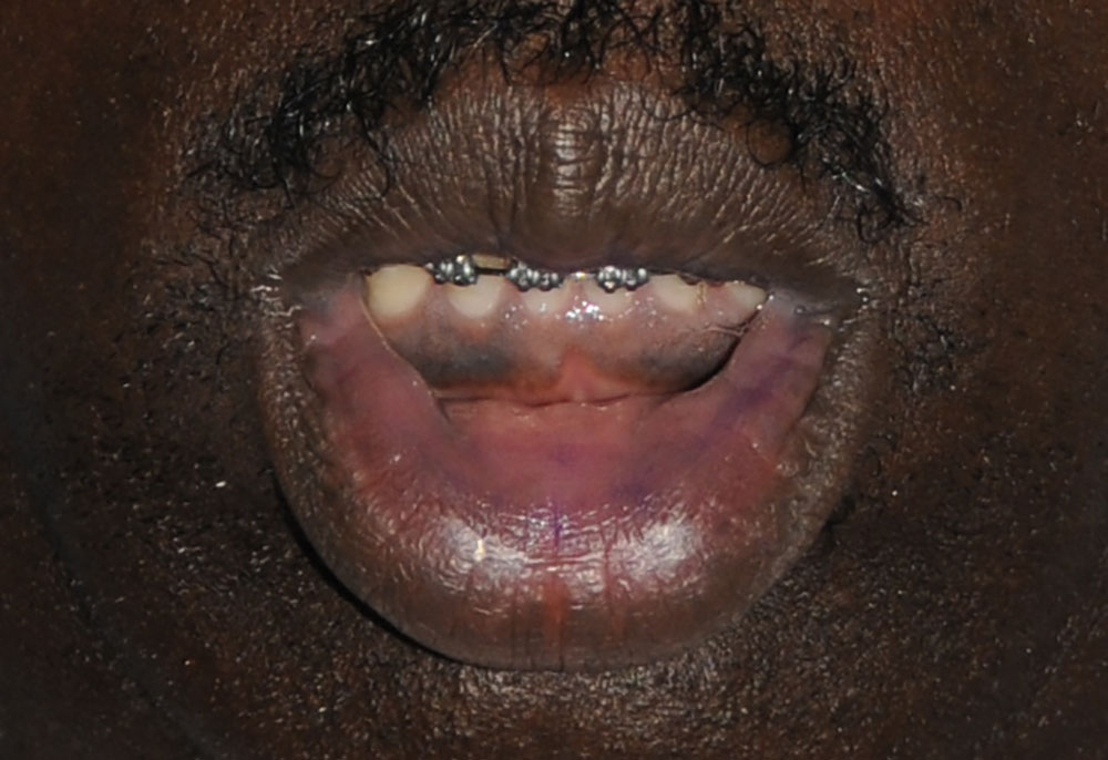 lip thinning reduction for an african black american before image