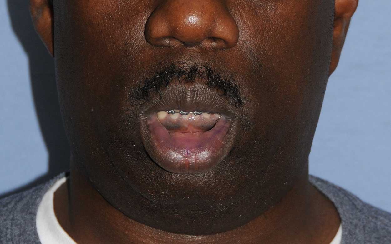 lip thinning reduction for an african black american before image