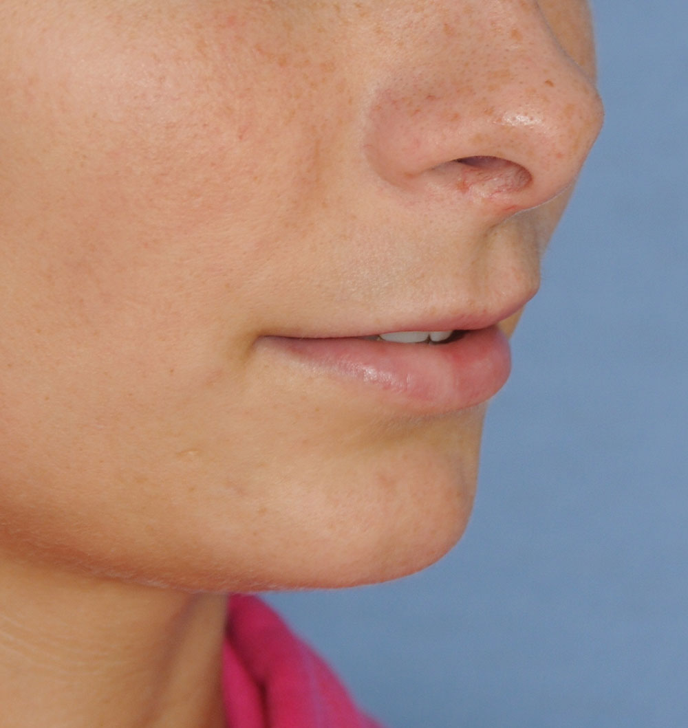 Before PermaLip Silicone Lip Implants Augmentation Oblique View