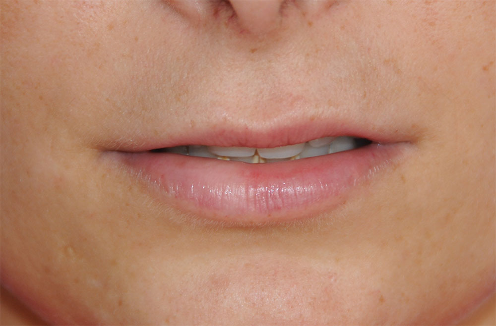 Before PermaLip Silicone Lip Implants Augmentation Front View