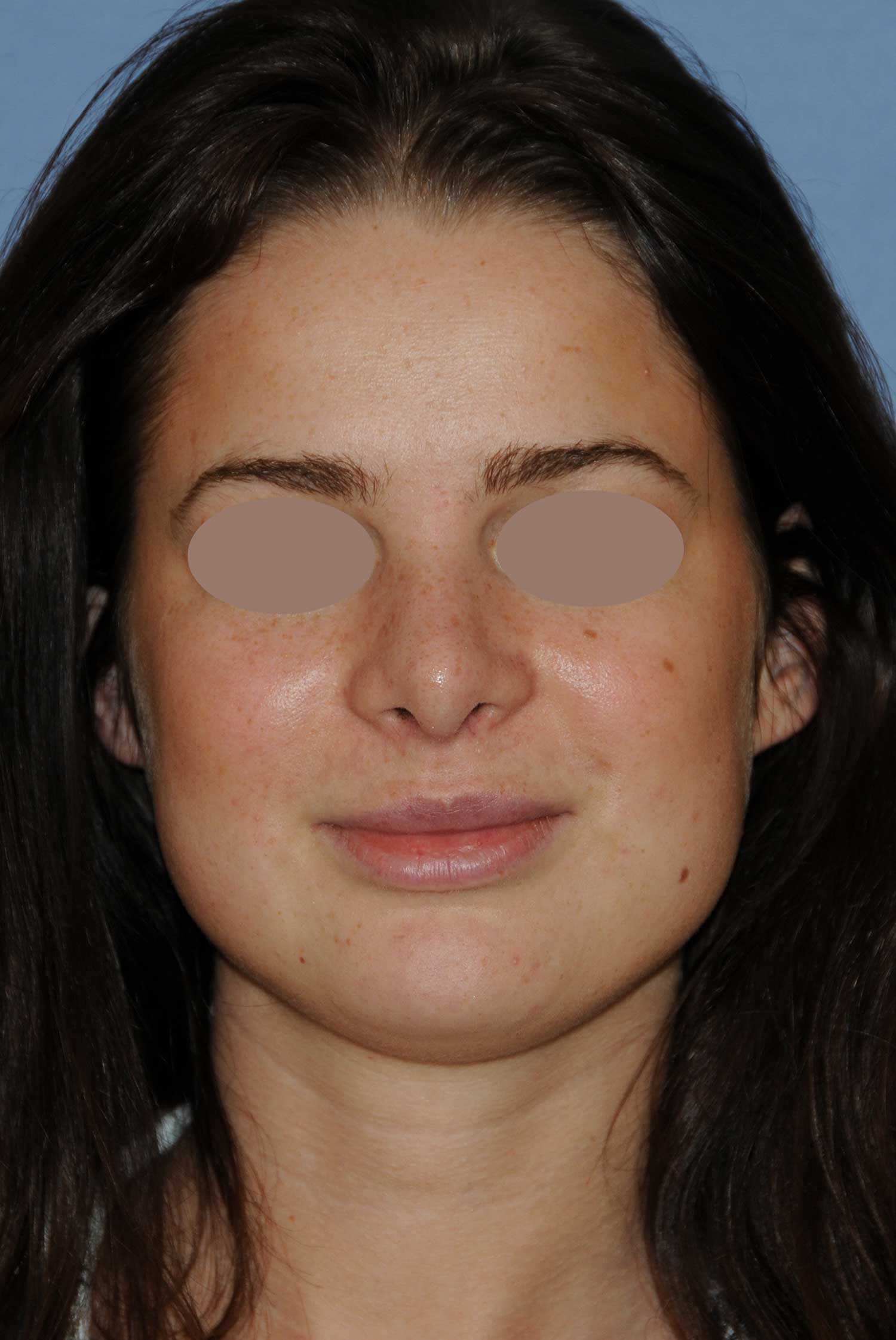 After Rhinoplasty For A Large, Wide Nasal Bridge and Bulbous Nasal Tip