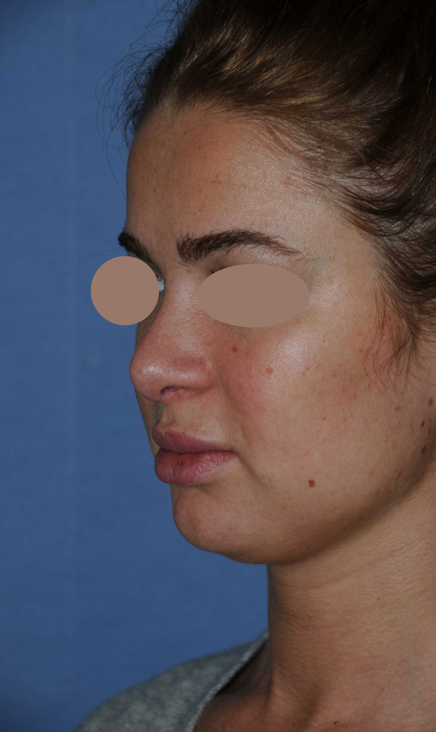 After Rhinoplasty For A Large, Wide Nasal Bridge and Bulbous, Hook, & Hanging Nasal Tip Left Oblique Angled View