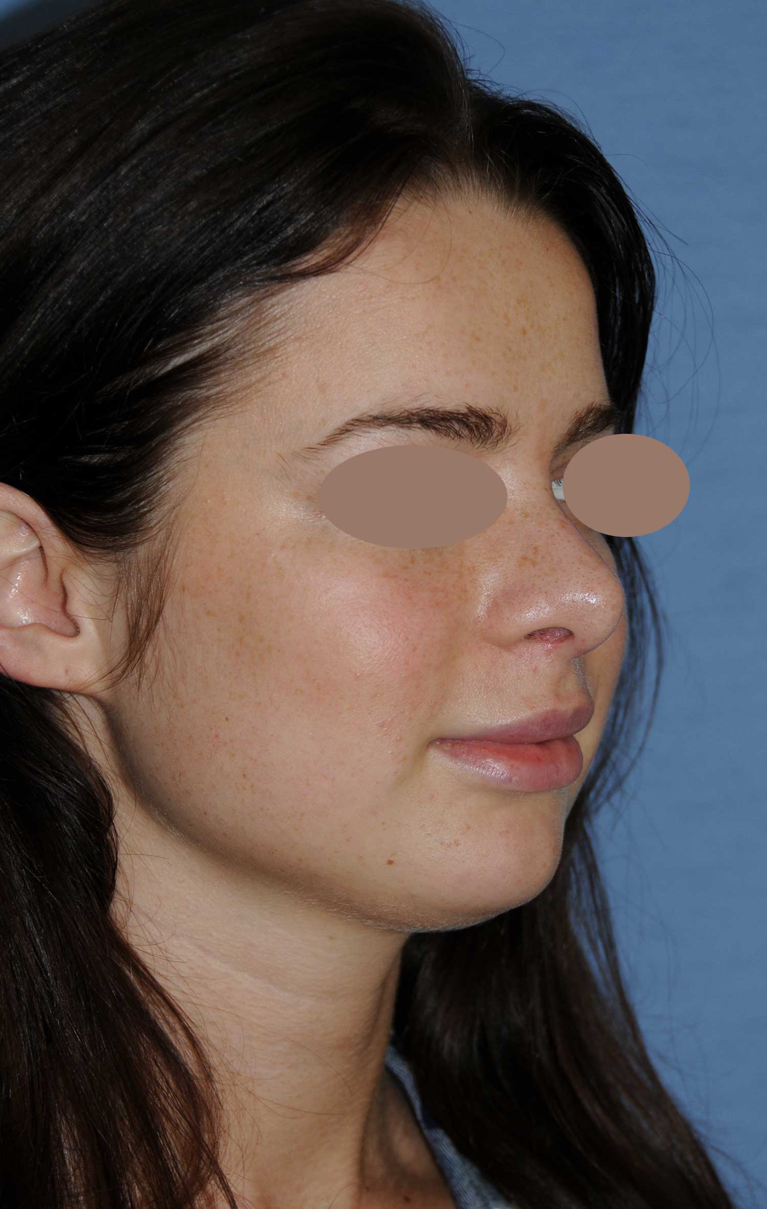 After Rhinoplasty For A Large, Wide Nasal Bridge and Bulbous, Hook, & Hanging Nasal Tip Oblique Angled View