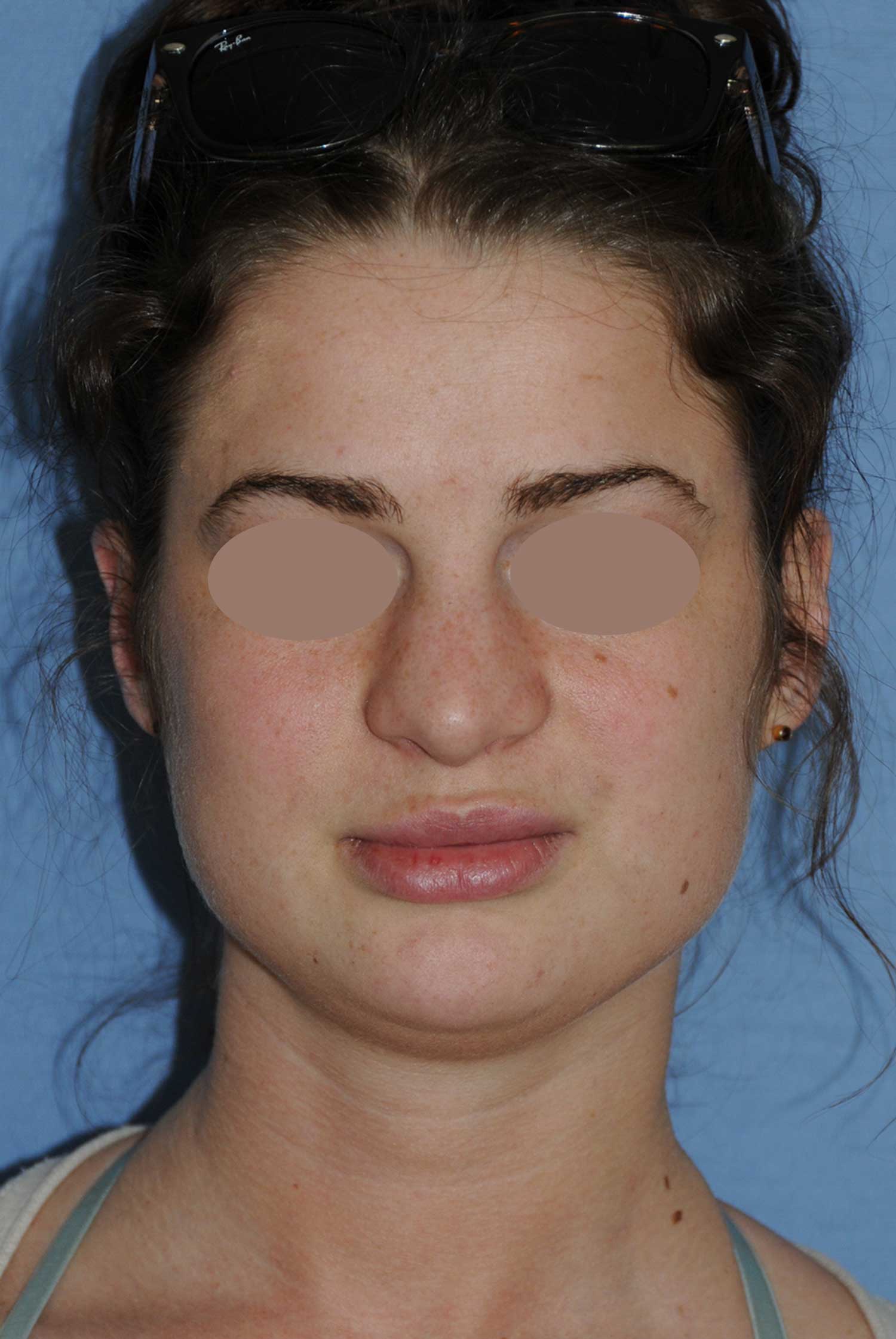 Before Rhinoplasty For A Large, Wide Nasal Bridge and Bulbous Nasal Tip