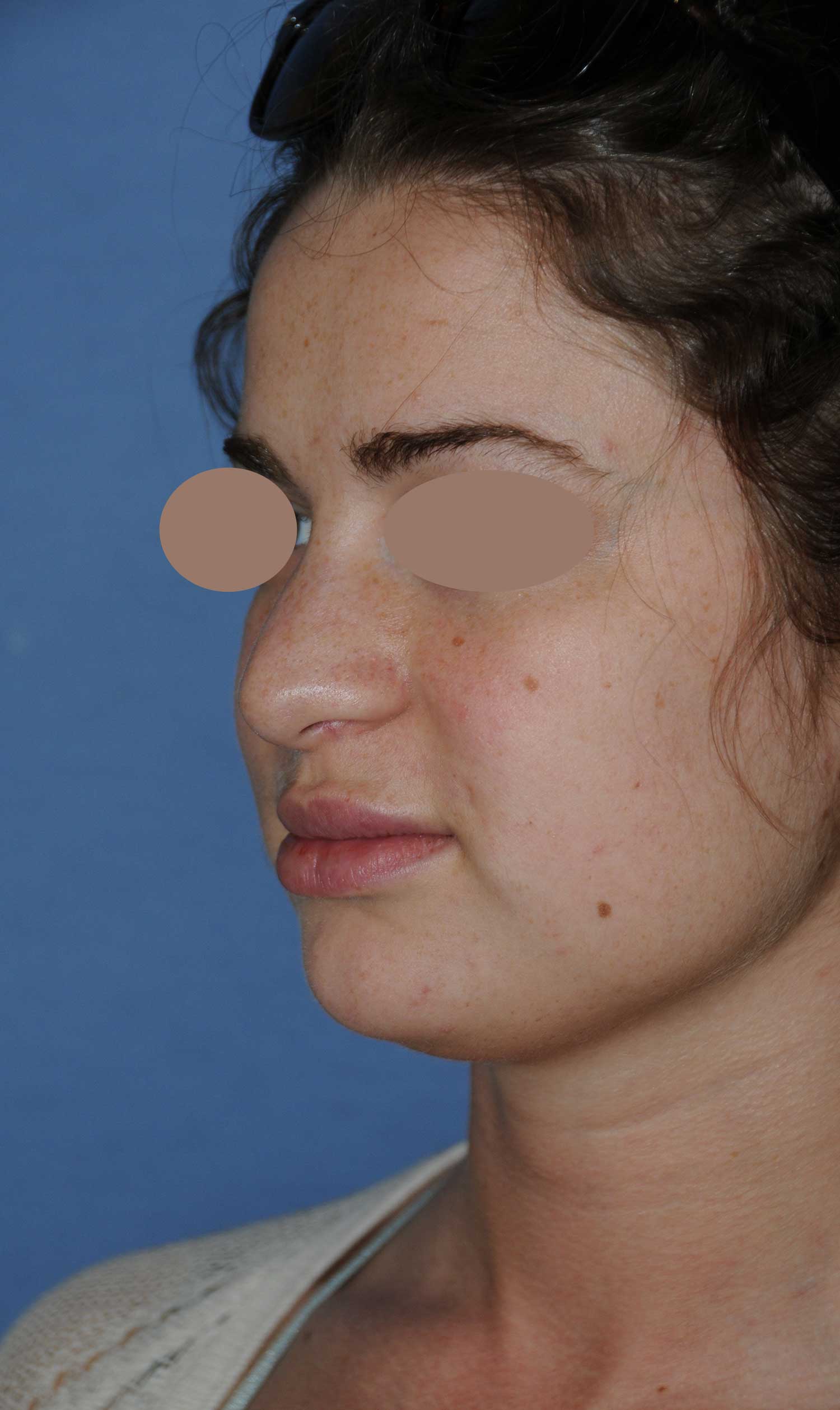 Before Rhinoplasty For A Large, Wide Nasal Bridge and Bulbous, Hook, & Hanging Nasal Tip Left Oblique Angled View