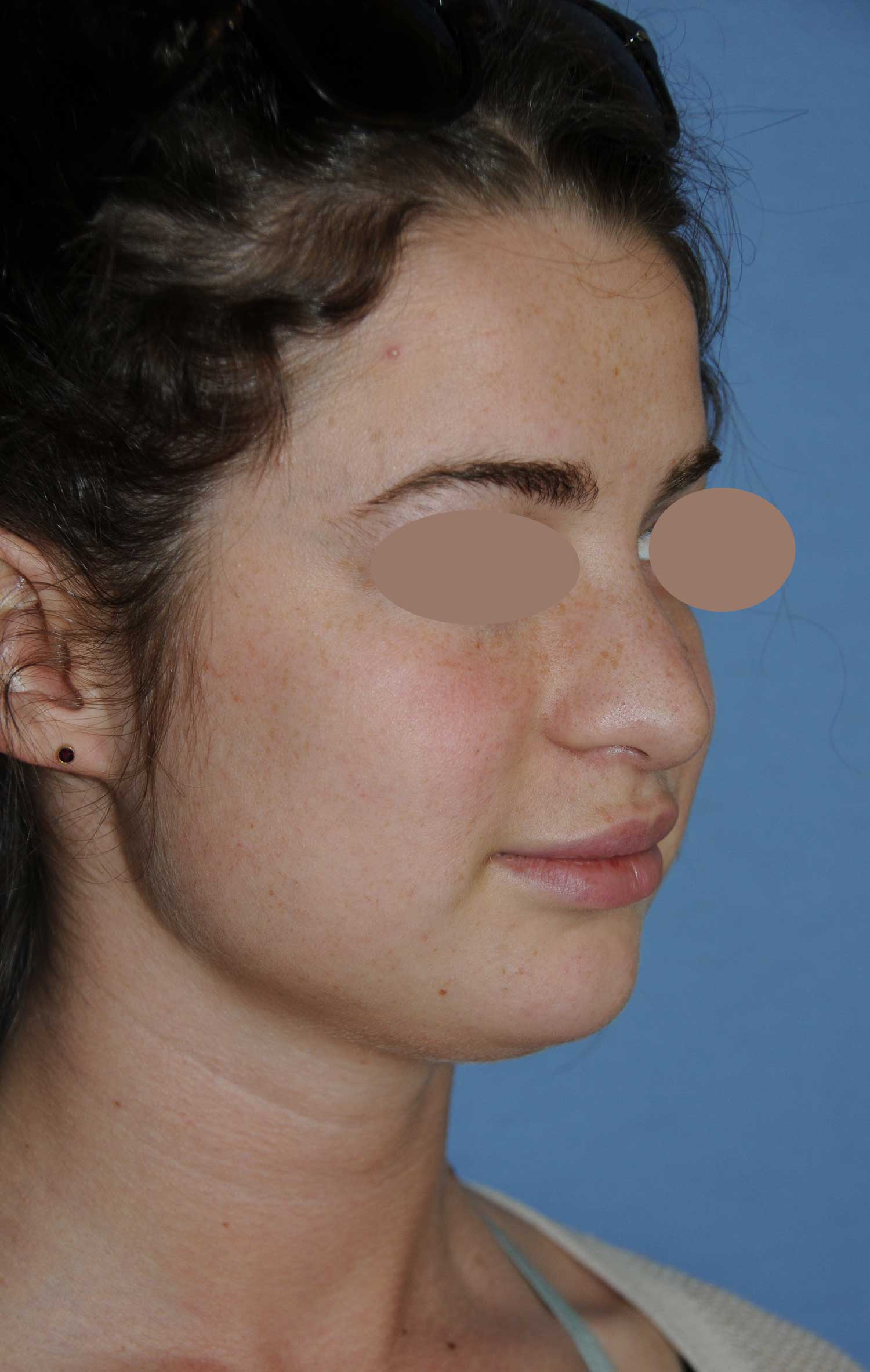 Before Rhinoplasty For A Large, Wide Nasal Bridge and Bulbous, Hook, & Hanging Nasal Tip Oblique Angled View