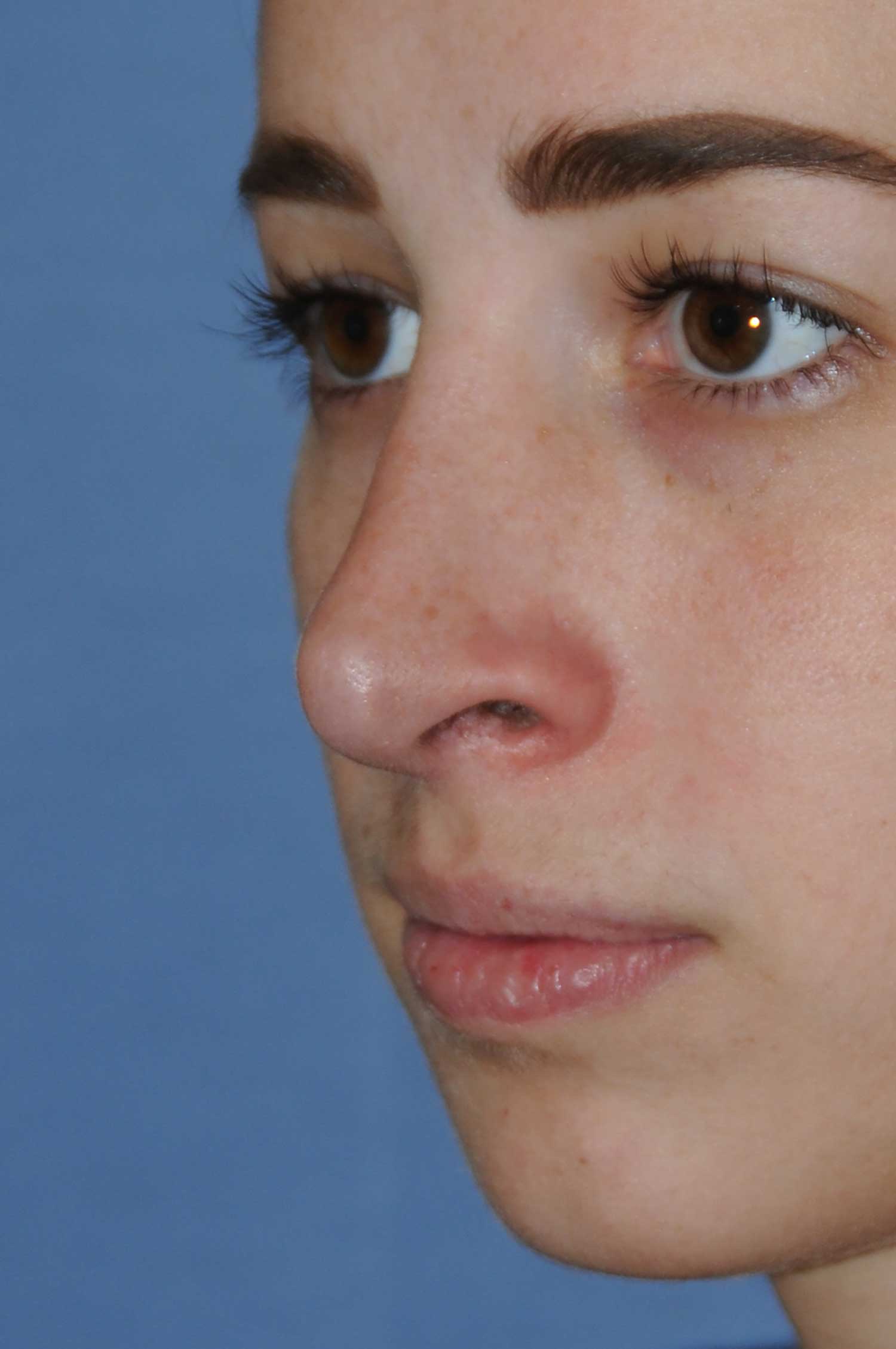 Rhinoplasty Before & After Photos Seattle Bellevue