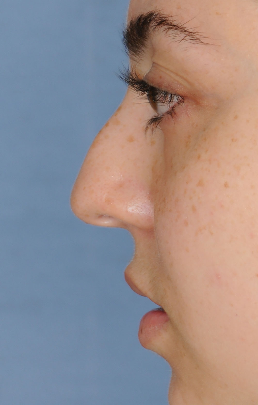 Rhinoplasty for a Bulbous Nasal Tip, Prominent Nasal Bridge, Short Nose / Columella and Lip Fat Transfer for Small Thin Lateral Upper Outer Lips Before Left Profile Close Up View