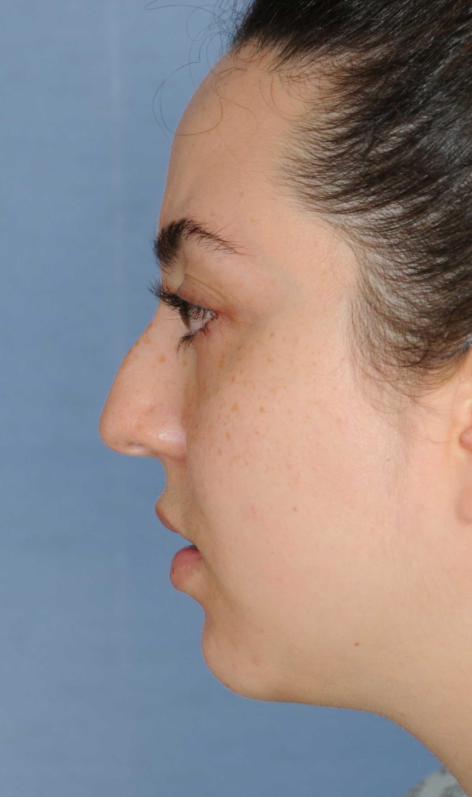 Rhinoplasty for a Bulbous Nasal Tip, Prominent Nasal Bridge, Short Nose / Columella and Lip Fat Transfer for Small Thin Lateral Upper Outer Lips Before Left Profile View