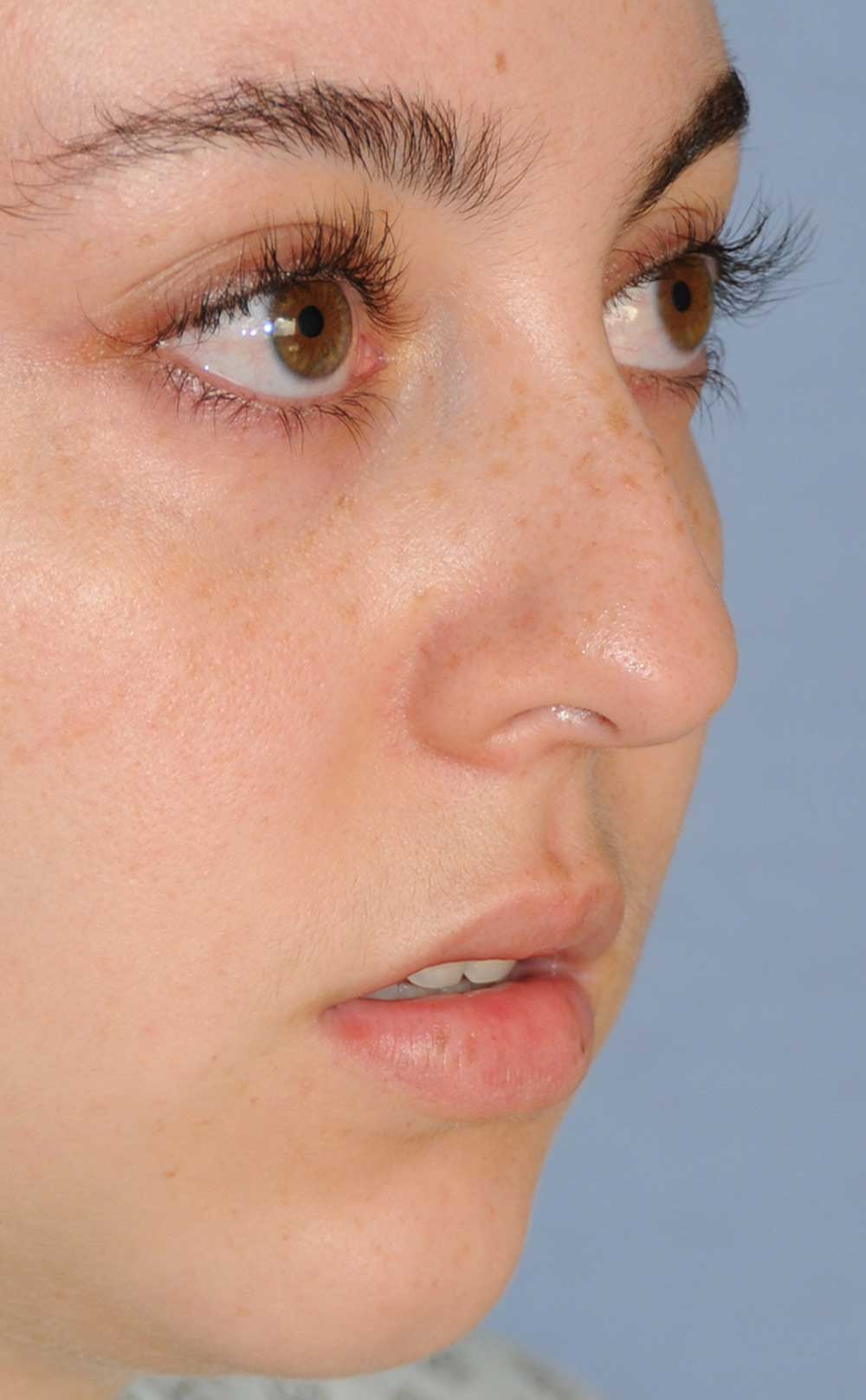 Rhinoplasty for a Bulbous Nasal Tip, Prominent Nasal Bridge, Short Nose / Columella and Lip Fat Transfer for Small Thin Lateral Upper Outer Lips Before Right Oblique View