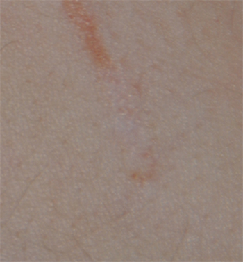 Self Harm Injury Scar Treatment After Image From Co2 Lasering Close Up