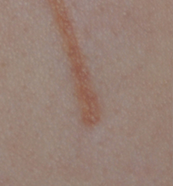 Self Harm Injury Scar Treatment Before Image From Co2 Lasering Close Up