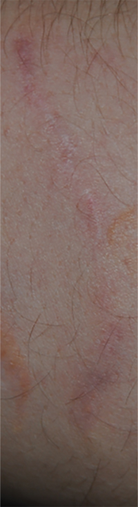 Self Harm Injury Scar Treatment After Image From Excision (Cutting the Scar Out) Close Up