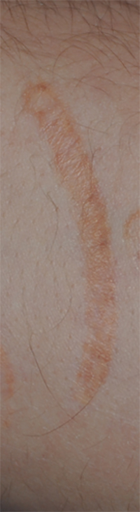 Self Harm Injury Scar Treatment Before Image From Excision (Cutting the Scar Out) Close Up